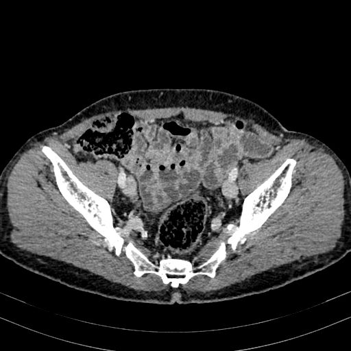Abdominal aortic aneurysm (Radiopaedia 83581-98689 Axial C+ portal venous phase 93).jpg