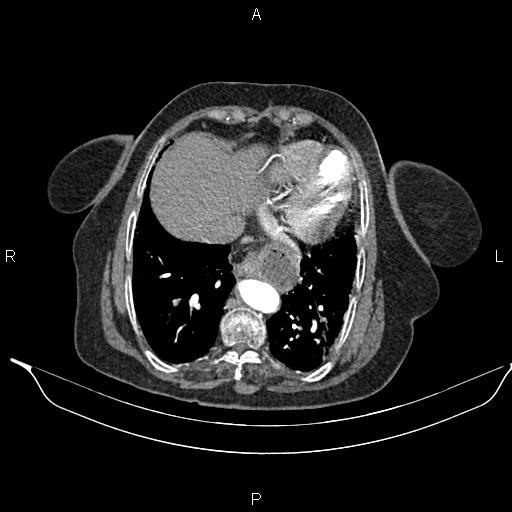 File:Abdominal aortic aneurysm (Radiopaedia 85063-100606 Axial C+ arterial phase 24).jpg