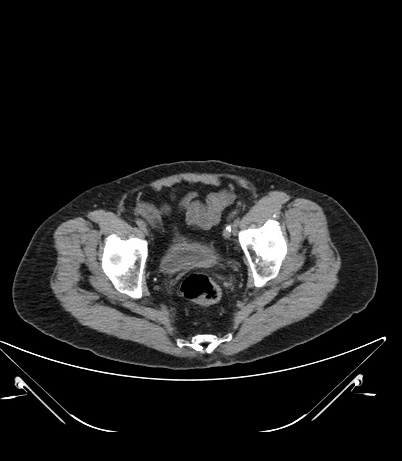 Abdominal aortic aneurysm with thrombus fissuration (Radiopaedia 46218-50618 Axial non-contrast 52).jpg