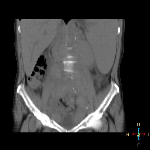 File:Abdominal lymphoma (Radiopaedia 23085-23115 Coronal non-contrast 14).jpg