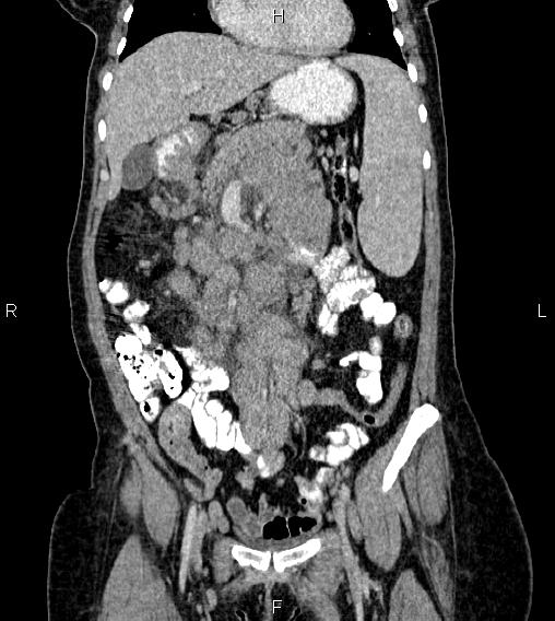 File:Abdominal lymphoma with sandwich sign (Radiopaedia 84378-99704 Coronal C+ portal venous phase 19).jpg