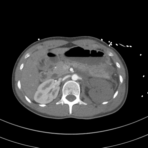File:Abdominal multi-trauma - devascularised kidney and liver, spleen and pancreatic lacerations (Radiopaedia 34984-36486 Axial C+ arterial phase 103).png