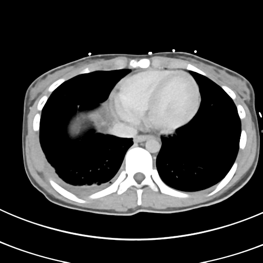File:Abdominal multi-trauma - devascularised kidney and liver, spleen and pancreatic lacerations (Radiopaedia 34984-36486 Axial C+ delayed 2).png