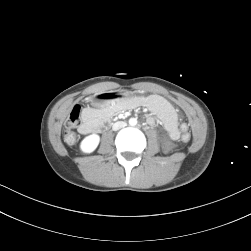 Abdominal multi-trauma - devascularised kidney and liver, spleen and pancreatic lacerations (Radiopaedia 34984-36486 Axial C+ portal venous phase 42).png