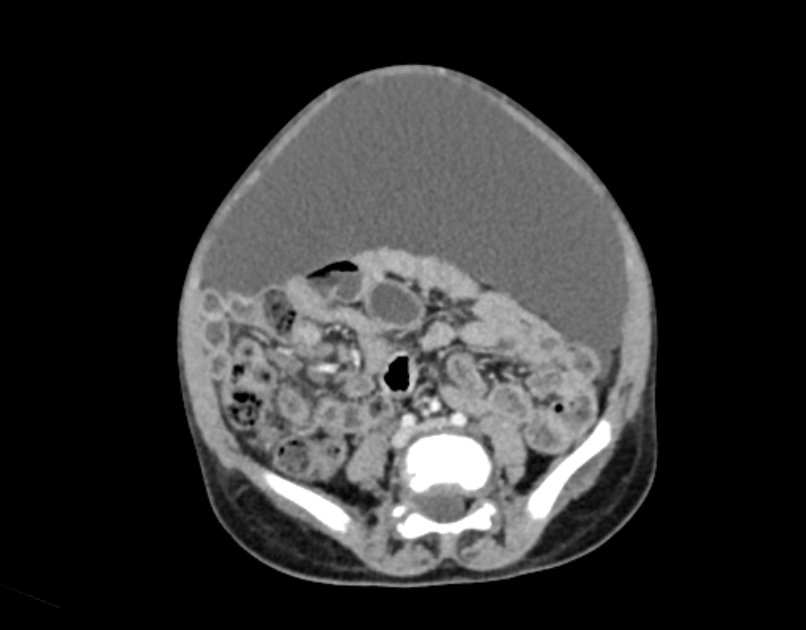 Abdominal premesenteric cystic lymphangioma (Radiopaedia 82995-97350 Axial C+ portal venous phase 42).jpg