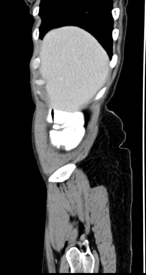 Abdominal wall and retroperitoneal tuberculosis (Radiopaedia 88137-104729 Sagittal C+ portal venous phase 132).jpg