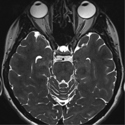 Abducens nerve palsy (Radiopaedia 51069-56648 Axial T2 fat sat 56).png