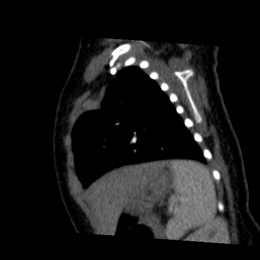 Aberrant left pulmonary artery (pulmonary sling) (Radiopaedia 42323-45435 Sagittal C+ arterial phase 44).jpg