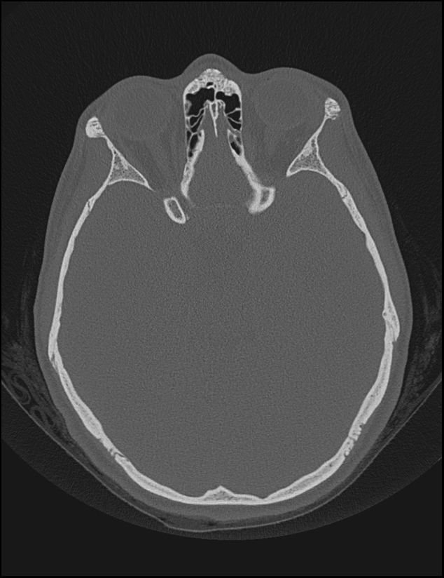 Aberrant right internal carotid artery (Radiopaedia 65191-74198 Axial non-contrast 75).jpg