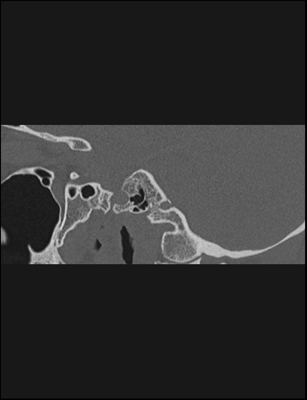 Aberrant right internal carotid artery (Radiopaedia 65191-74198 Sagittal non-contrast 79).jpg