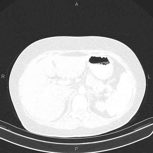 Aberrant right subclavian artery (Radiopaedia 87334-103629 Axial lung window 70).jpg
