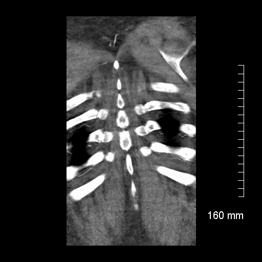 Aberrant right subclavian artery stenosis (Radiopaedia 52656-58670 B 77).jpg