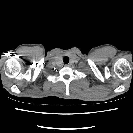 Accessory left horizontal fissure with lingular pneumonia (Radiopaedia 53763-59843 Axial C+ CTPA 4).jpg