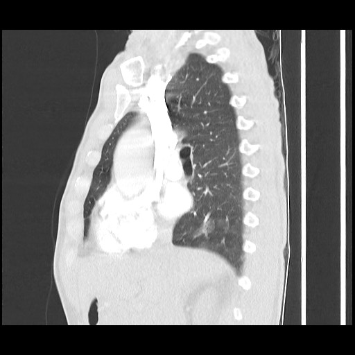 Accessory left horizontal fissure with lingular pneumonia (Radiopaedia 53763-59843 Sagittal lung window 30).jpg