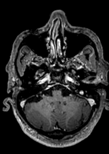 File:Accessory middle cerebral artery (Radiopaedia 73114-83828 Axial T1 C+ 140).jpg