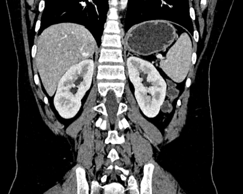 Accessory right inferior hepatic vein (Radiopaedia 75207-86305 Coronal C+ portal venous phase 54).jpg