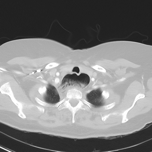 File:Achalasia (Radiopaedia 47147-51685 Axial lung window 6).png