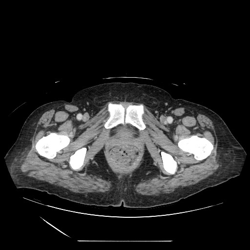 Acinar cell carcinoma of the pancreas (Radiopaedia 75442-86669 Axial C+ portal venous phase 148).jpg