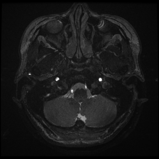 Acoustic neuroma (Radiopaedia 34049-35283 Axial 9).png
