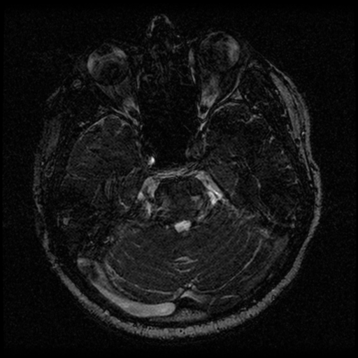 Acoustic schwannoma (Radiopaedia 33045-34060 Axial T2 53).png