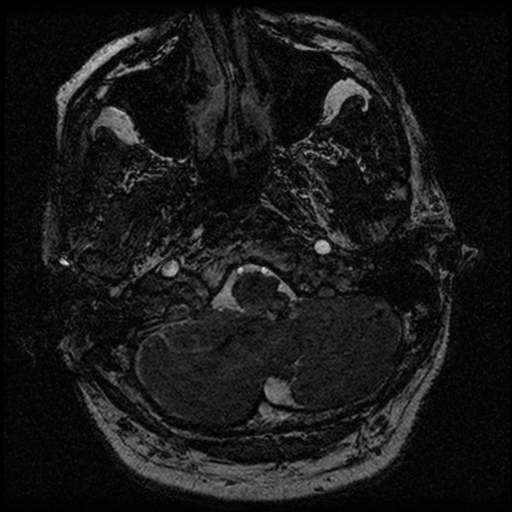 File:Acoustic schwannoma (Radiopaedia 39170-41387 Axial FIESTA 26).png