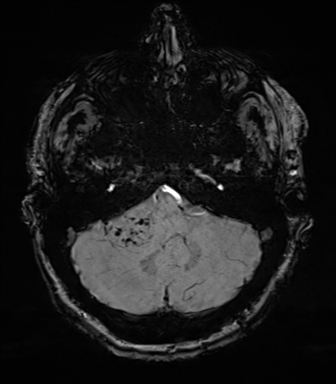 File:Acoustic schwannoma (Radiopaedia 50846-56358 Axial SWI 20).png