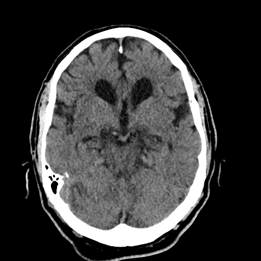 File:Acoustic schwannoma (Radiopaedia 55729-62280 Axial non-contrast 14).png