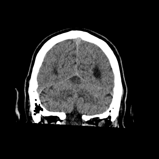 File:Acoustic schwannoma (Radiopaedia 55729-62280 Coronal non-contrast 32).png