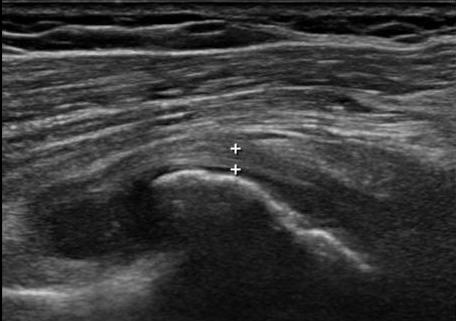 File:Acromioclavicular joint ganglion and long head of biceps brachii dislocation (Radiopaedia 12938-13043 C 1).jpg