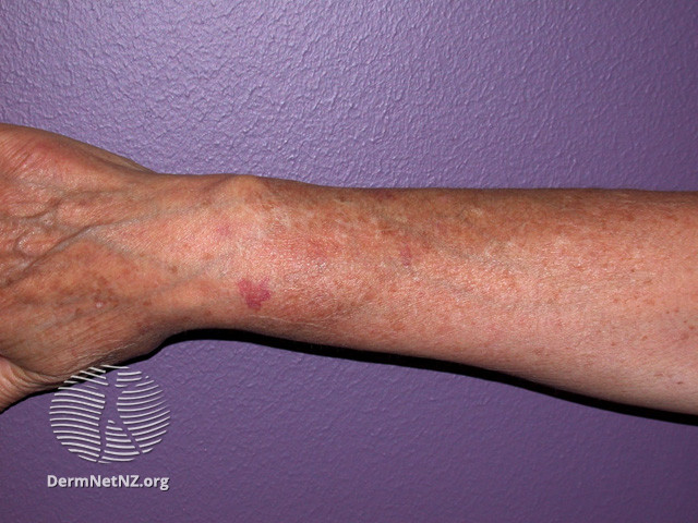 File:Actinic keratoses affecting the hands (DermNet NZ lesions-ak-hands-313).jpg