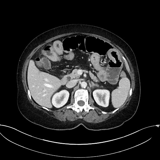 Active Crohn disease (Radiopaedia 59394-66750 Axial C+ portal venous phase 25).jpg