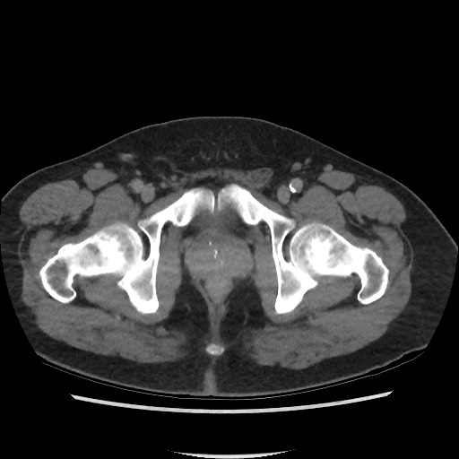 File:Active colonic bleed on CT (Radiopaedia 49765-55025 Axial C+ delayed 82).jpg