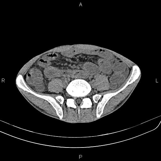 Active crohn disease (Radiopaedia 87133-103397 Axial non-contrast 70).jpg