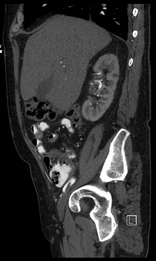 Active lower gastrointestinal bleeding - diverticular (Radiopaedia 61203-69106 Sagittal C+ arterial phase 112).jpg