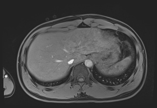 File:Active right ventricular cardiac sarcoidosis (Radiopaedia 55596-62100 Axial Post contrast Dixon 71).jpg