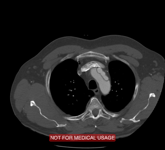Acute aortic dissection - Stanford type A (Radiopaedia 40661-43285 Axial C+ arterial phase 2).jpg