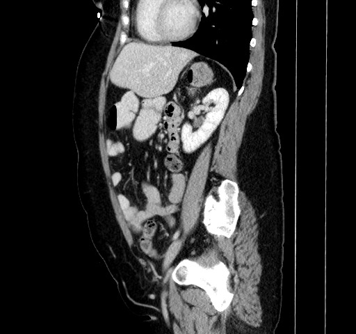 Acute appendicitis, heterotaxy syndrome (Radiopaedia 66884-76202 Sagittal C+ portal venous phase 88).jpg