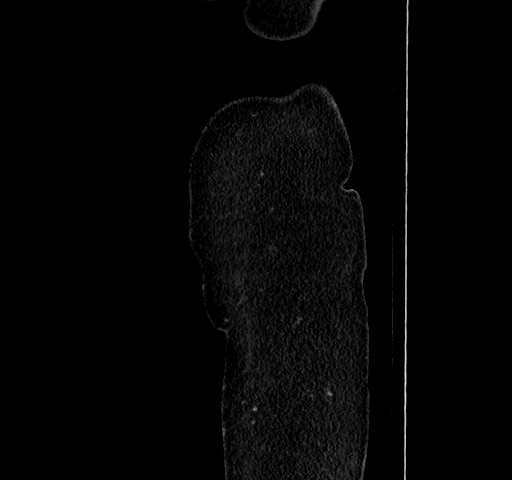 Acute appendicitis, heterotaxy syndrome (Radiopaedia 66884-76202 Sagittal C+ portal venous phase 9).jpg