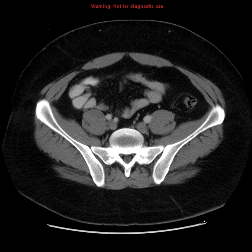 File:Acute appendicitis (Radiopaedia 12326-12607 Axial C+ portal venous phase 34).jpg