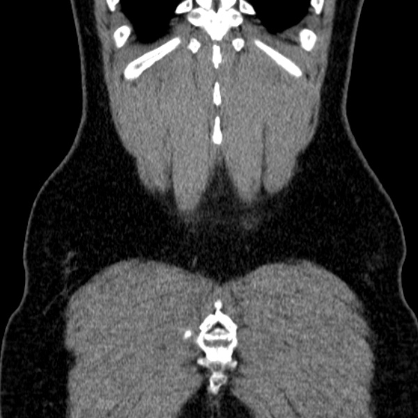 Acute appendicitis (Radiopaedia 38255-40270 Coronal C+ portal venous phase 80).jpg