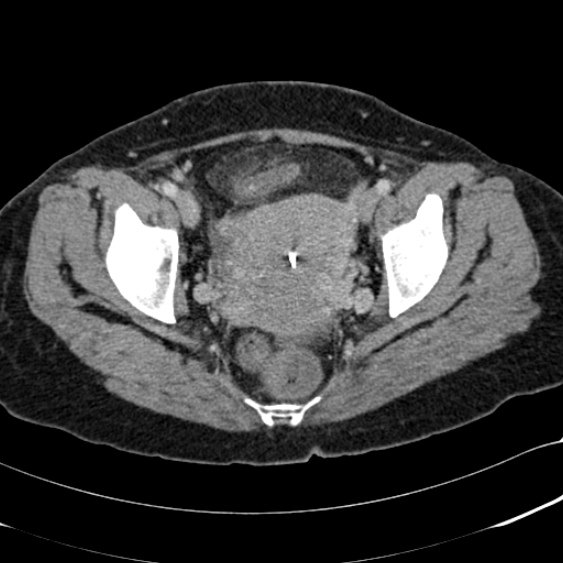 File:Acute appendicitis (Radiopaedia 48792-53822 Axial C+ portal venous phase 105).jpg