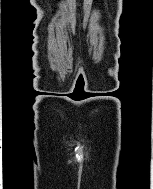 Acute appendicitis (Radiopaedia 58627-65818 Coronal non-contrast 63).jpg