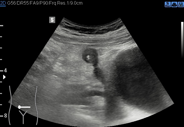 File:Acute appendicitis (Radiopaedia 85193-100745 B 100).jpg