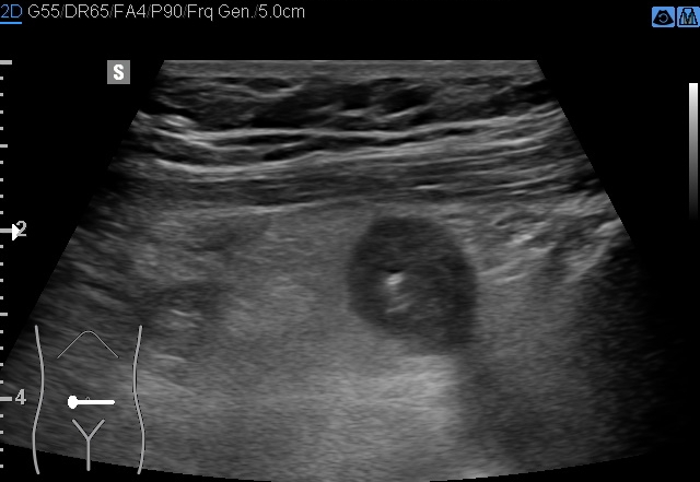 File:Acute appendicitis (Radiopaedia 85193-100745 D 168).jpg