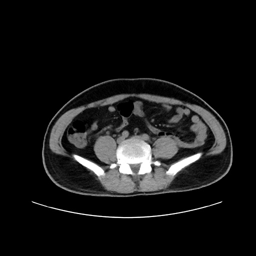 Acute appendicitis and COVID 19 pneumonia (Radiopaedia 76604-88380 Axial non-contrast 90).jpg