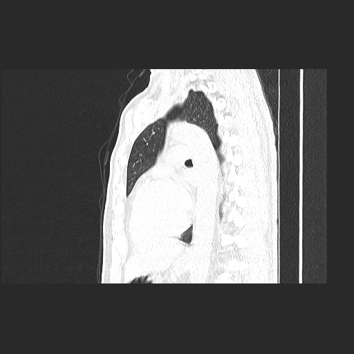 Acute appendicitis and COVID 19 pneumonia (Radiopaedia 76604-88380 Sagittal lung window 58).jpg