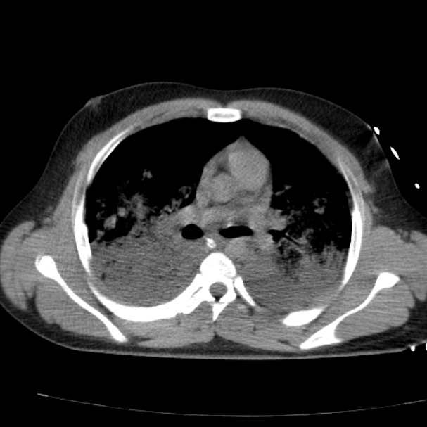 Acute aspiration pneumonitis (Radiopaedia 33605-34703 Axial non-contrast 43).jpg