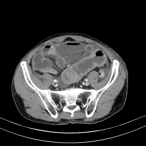 Acute bowel ischemia (Radiopaedia 87695-104114 Axial C+ portal venous phase 65).jpg