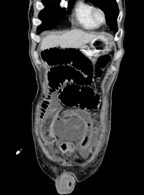 Acute bowel ischemia (Radiopaedia 87695-104114 Coronal C+ portal venous phase 103).jpg