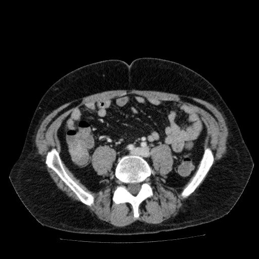 File:Acute cholecystitis and incidental left sided IVC (Radiopaedia 49352-54459 Axial C+ portal venous phase 101).jpg